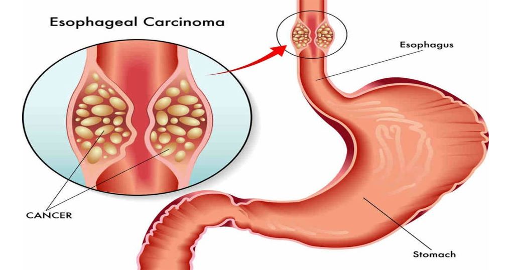 Robotic oesophagus cancer surgery Delhi