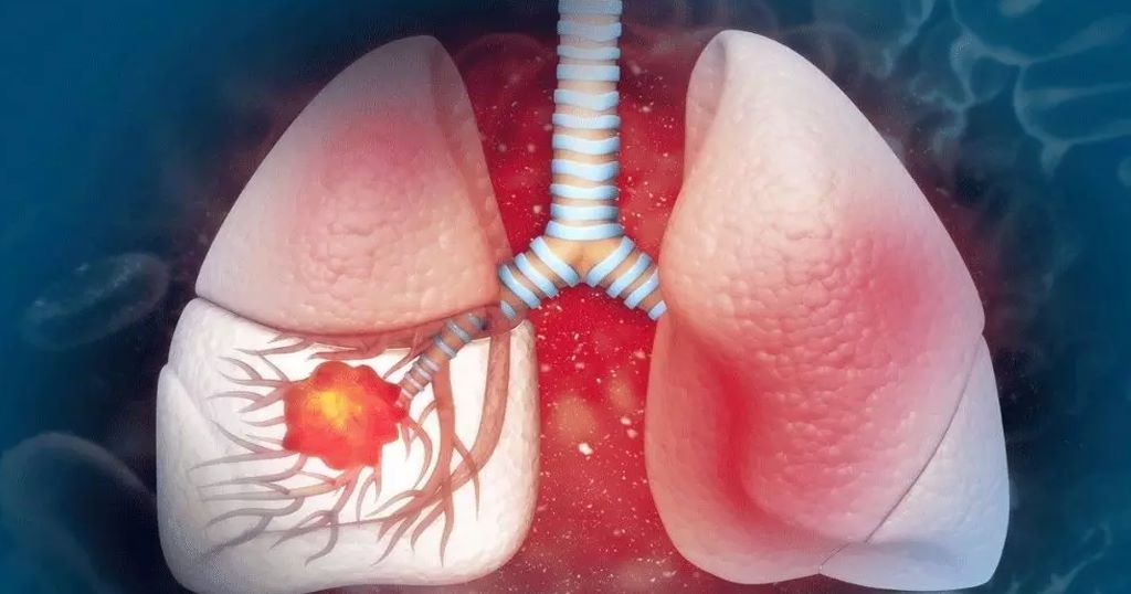 Lung Cancer Treatment in Delhi NCR