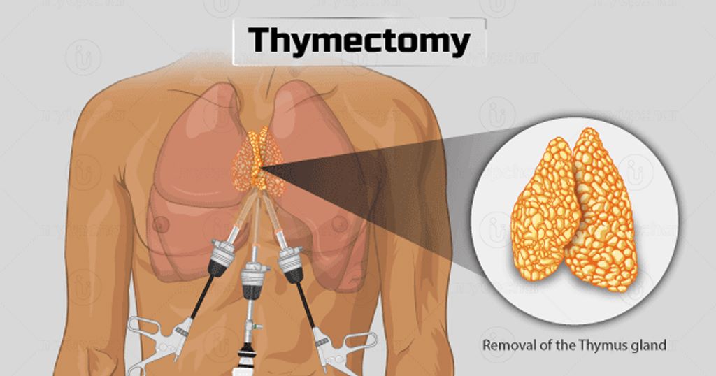 Robotic Thymoma surgery in Delhi